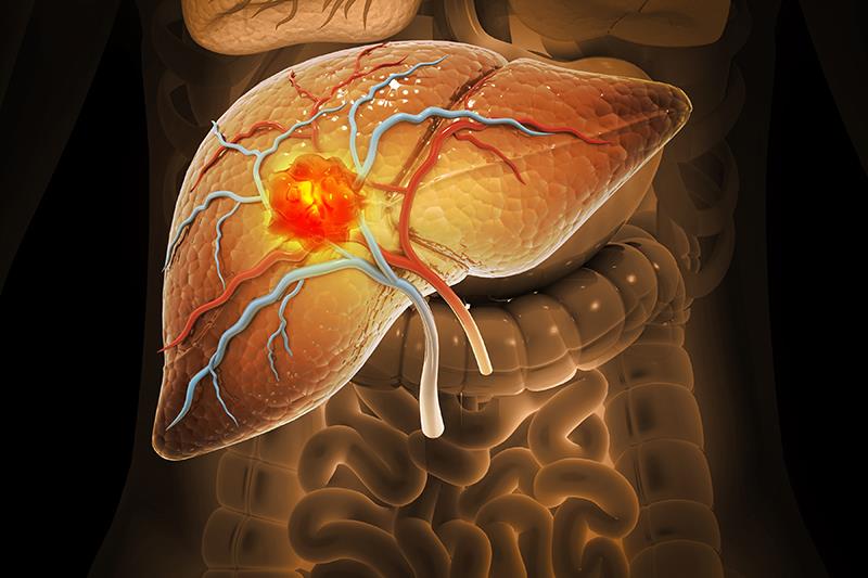 Frontline nivolumab plus ipilimumab ups OS, ORR in patients with uHCC