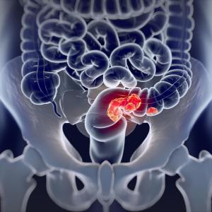 Biosimilar for metastatic colorectal cancer as effective as bevacizumab