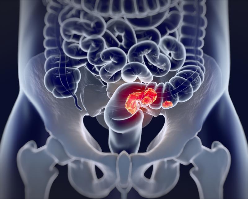 Biosimilar for metastatic colorectal cancer as effective as bevacizumab