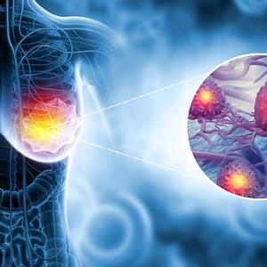 Fuzuloparib ± apatinib improves PFS in BRCA-mutated metastatic breast cancer