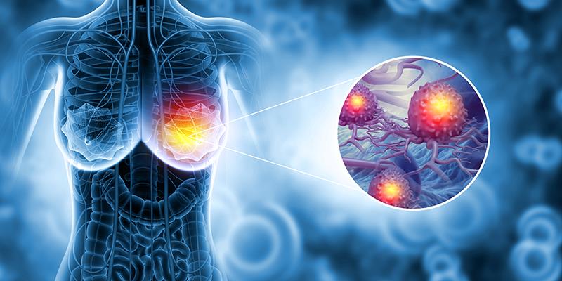 Fuzuloparib ± apatinib improves PFS in BRCA-mutated metastatic breast cancer
