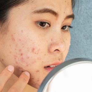 ANTIBIOTIC PRUDENCE A MUST IN ACNE
VULGARIS TREATMENT