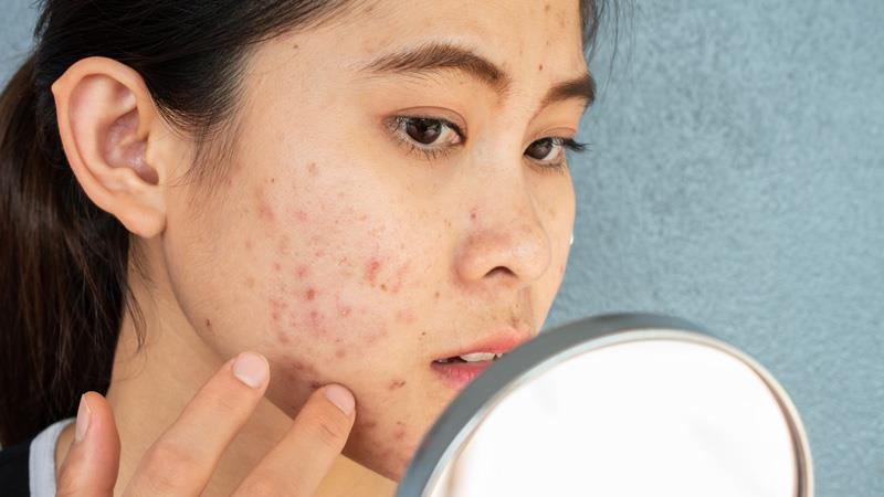 ANTIBIOTIC PRUDENCE A MUST IN ACNE
VULGARIS TREATMENT