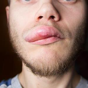 Garadacimab, berotralstat reduce attacks in hereditary angioedema