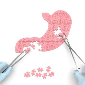 Sleeve gastrectomy beats RYGB in reducing fracture risk in obese patients