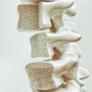 Denosumab an option for high-risk glucocorticoid-induced osteoporosis