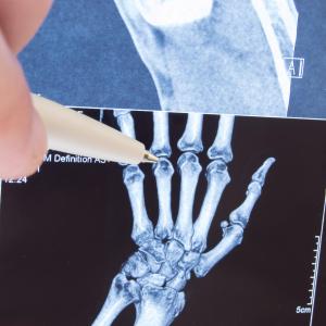 Canakinumab delivers rapid, durable benefits in systemic juvenile idiopathic arthritis