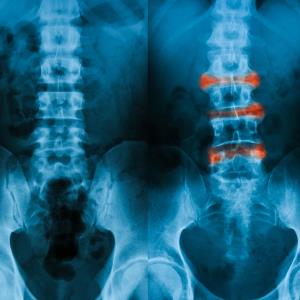 Golimumab shows sustained efficacy for ankylosing spondylitis