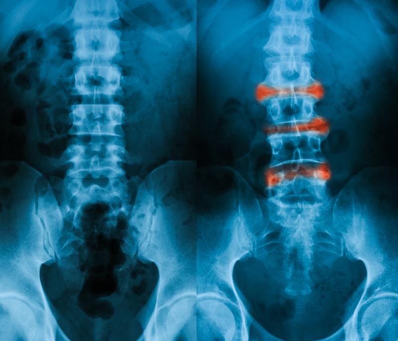 Golimumab shows sustained efficacy for ankylosing spondylitis