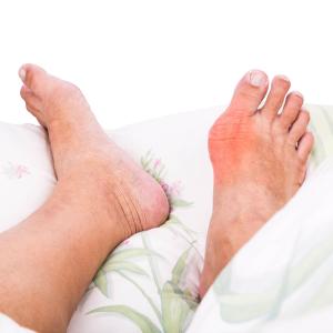 Gout patients endorse reasons for not taking allopurinol