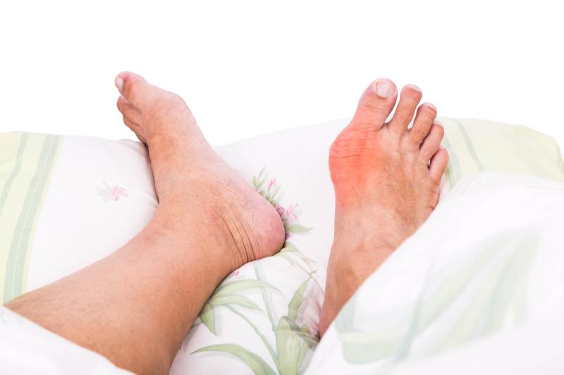 Gout patients endorse reasons for not taking allopurinol