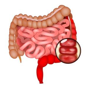 UC patients on guselkumab maintenance therapy achieve clinical remission