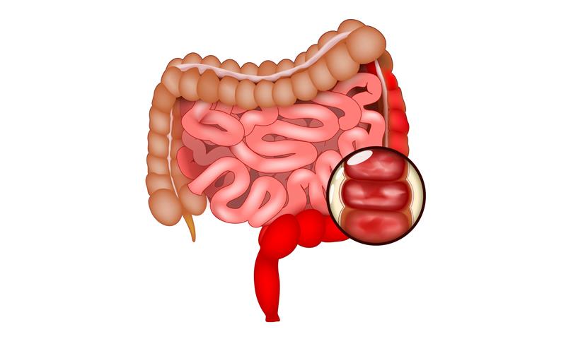UC patients on guselkumab maintenance therapy achieve clinical remission