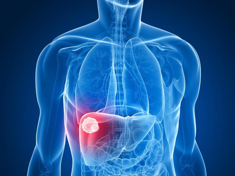 Pegylated recombinant human arginase monotherapy well tolerated in post-sorafenib HCC