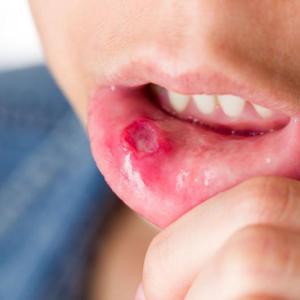 Adjunctive sucralfate falls short of improving oral intake in kids with infectious mouth ulcers