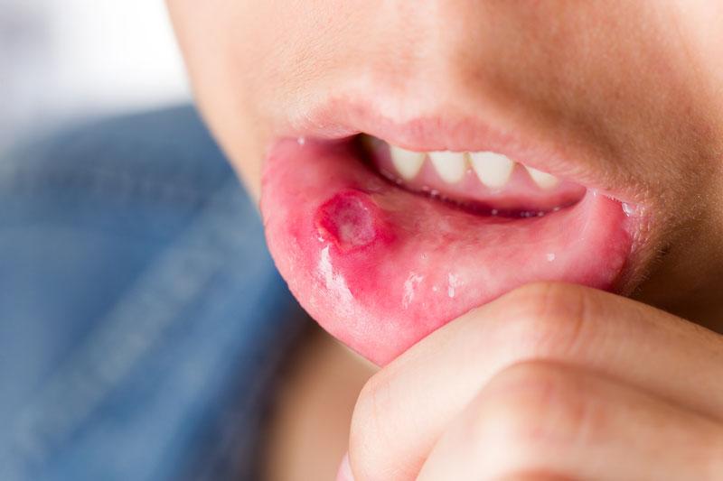 Adjunctive sucralfate falls short of improving oral intake in kids with infectious mouth ulcers