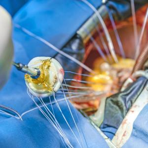 Balloon-expandable, self-expanding valves comparable for TAVI