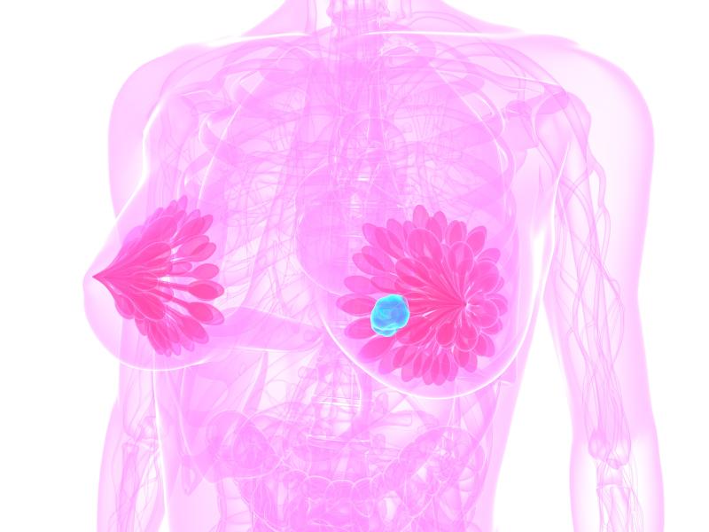 Omeprazole helps inhibit fatty acid synthase activity in triple-negative breast cancer