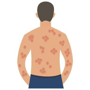 Hidradenitis suppurativa patients get durable benefit with bimekizumab