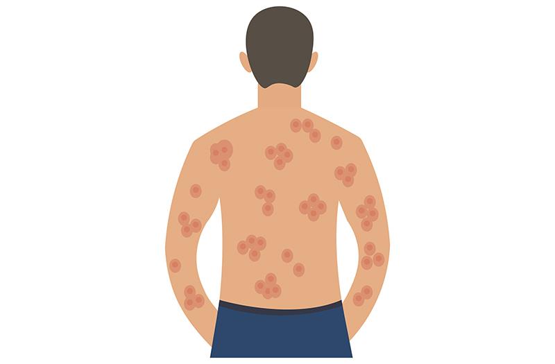 Hidradenitis suppurativa patients get durable benefit with bimekizumab