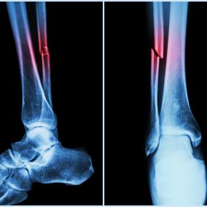 Timing of extremity fracture fixation does not affect functional outcomes in patients with TBI