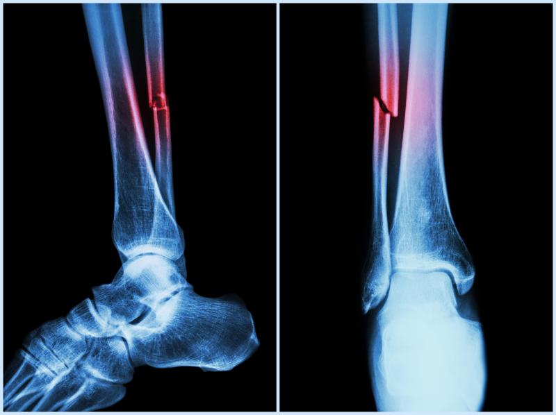 Timing of extremity fracture fixation does not affect functional outcomes in patients with TBI