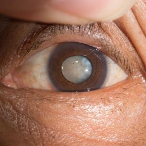 Cortical cataracts tied to systemic meds