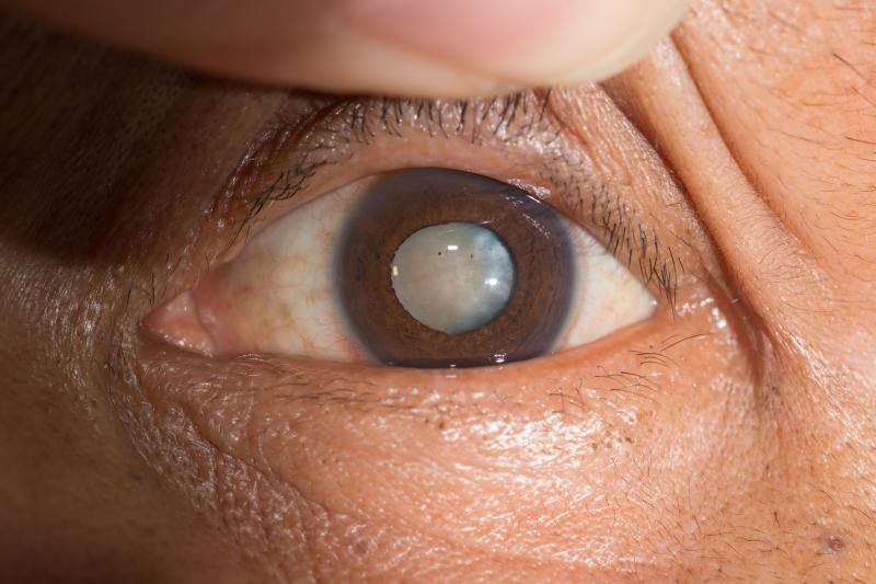 Cortical cataracts tied to systemic meds