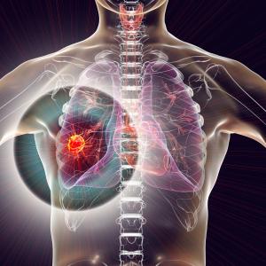 ICI-related adverse events tied to longer survival in metastatic NSCLC