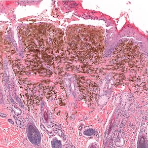 Atezolizumab–bevacizumab combo shows therapeutic potential in advanced mucosal melanoma