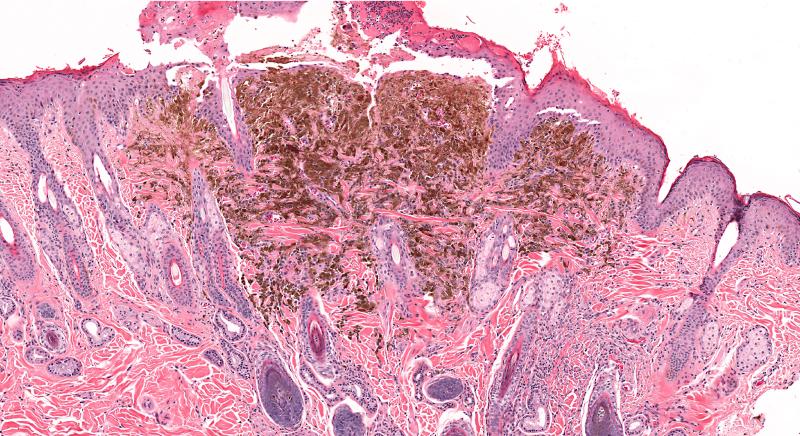 Atezolizumab–bevacizumab combo shows therapeutic potential in advanced mucosal melanoma