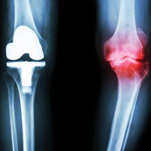 Tocilizumab trumps etanercept at suppressing RA joint erosion