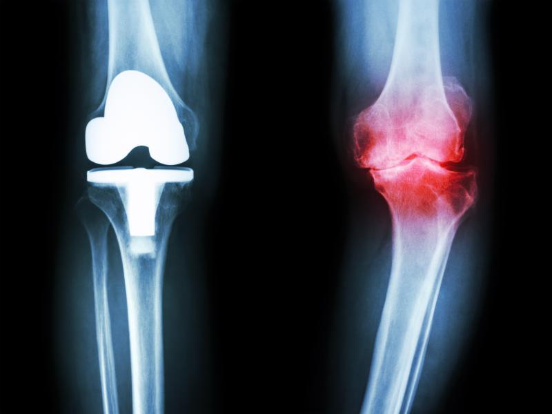 Tocilizumab trumps etanercept at suppressing RA joint erosion