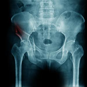 Bisphosphonates cut fracture risk in older cirrhosis patients