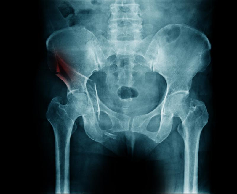 Bisphosphonates cut fracture risk in older cirrhosis patients