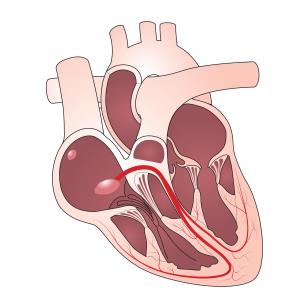 His-bundle pacing gains foothold in heart failure with LBBB