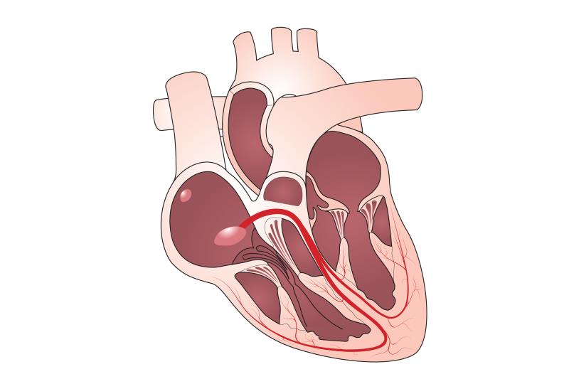 His-bundle pacing gains foothold in heart failure with LBBB