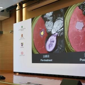 Histotripsy 2.0 available for liver and breast cancer clinical trials in HK