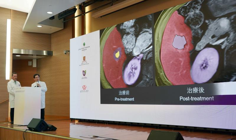 Prof James Griffith (left) and Prof Simon Ng (right) discussed the CUHK-PWH team's use of histotripsy in a liver cancer patie