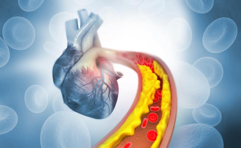 Use of a PCSK9 inhibitor in a patient with established ASCVD