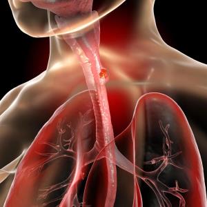 Clinical insights and updates on use of tislelizumab in advanced ESCC