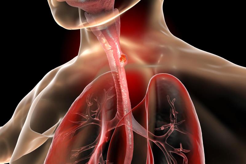 Clinical insights and updates on use of tislelizumab in advanced ESCC