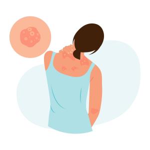 Addressing unmet needs in generalized pustular psoriasis: Real-world insights