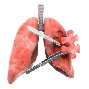 Neoadjuvant PD-1 ICI plus chemotherapy in early-stage resectable NSCLC