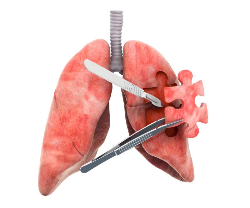 Neoadjuvant PD-1 ICI plus chemotherapy in early-stage resectable NSCLC