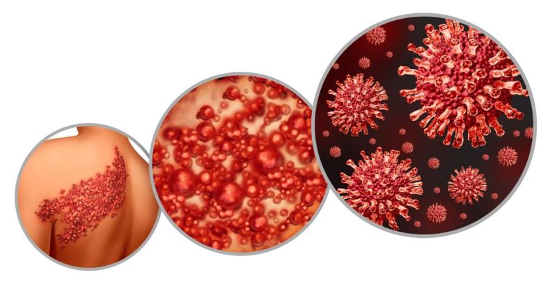 Prioritizing herpes zoster prevention in patients with chronic diseases or immune-compromised conditions