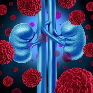 Pembrolizumab plus lenvatinib: A standard of care in first-line treatment of advanced RCC