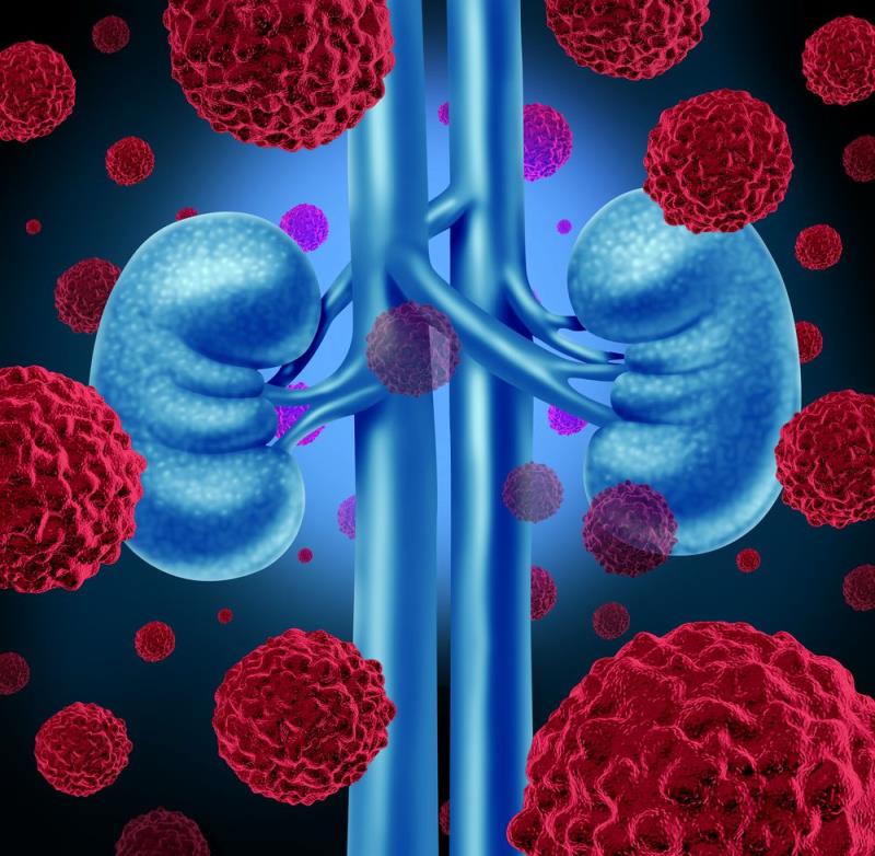 Pembrolizumab plus lenvatinib: A standard of care in first-line treatment of advanced RCC