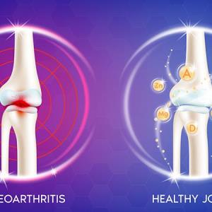 Topical NSAIDs in the Management of Osteoarthritis
Pain: A Consensus Approach by Malaysian Experts