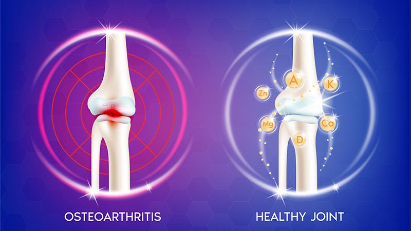 Topical NSAIDs in the Management of Osteoarthritis
Pain: A Consensus Approach by Malaysian Experts